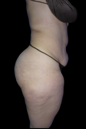 Lipo HD Antes