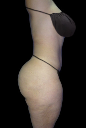 Lipo HD Después